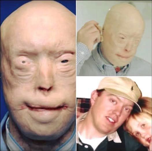 Firefighter Sustains Severe Burns—Here’s His Journey 11 Years Later